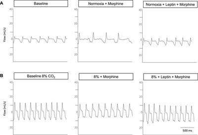 The efficacy of intranasal leptin for opioid-induced respiratory depression depends on sex and obesity state